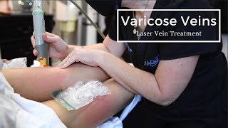 Foam sclerotherapy for treating spider veins and varicose veins [upl. by Dupaix79]