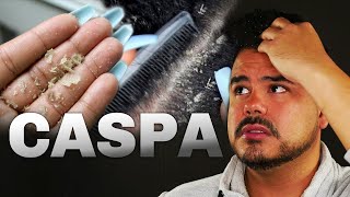 ⚠️ 7 RECOMENDACIONES y CAUSAS de LA CASPA  Médico Estético explica QUÉ ES LA CASPA  DR SAUCILLO [upl. by Ydoow]