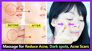 How to treat acne scars 2018 guide by Dermatologist [upl. by Kataway334]