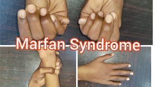 Marfan Syndrome  Clinical Signs [upl. by Dayiz]