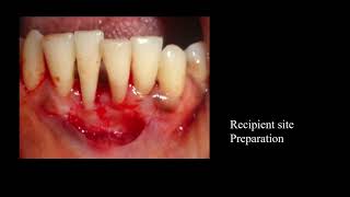 Freegingival Graft to increase width of Attached Gingiva [upl. by Erdnaek298]