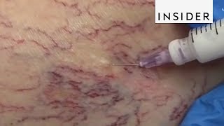 Treatment for Varicose Veins  Nucleus Health [upl. by Llerrah]