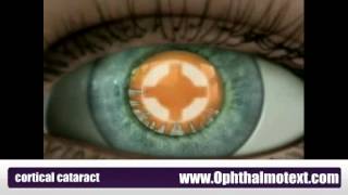 Cortical cataract [upl. by Tinor]