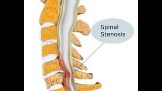 Estenosis Espinal [upl. by Dianuj]