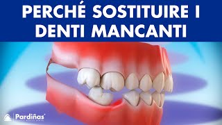 Implantologia  Conseguenze di non sostituire il denti mancanti © [upl. by Enilesoj259]