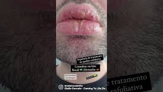 Queilite esfoliativa evolução do tratamento exfoliative cheilitis  treatment estomatologista [upl. by Atnes]