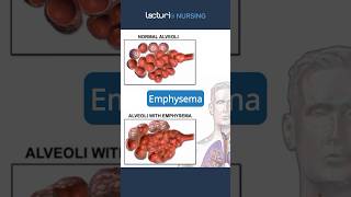 Exploring Emphysema 🔍 Emphysema RespiratoryCare nclexrn [upl. by Annaehs775]