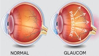 Ce este Glaucomul [upl. by Wenonah398]