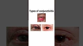 Types Of Conjunctivitis nationalpandeyg redeye eyediseases eyecare [upl. by Aerol]