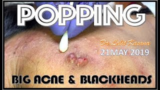 BIG PIMPLE and BLACKHEAD POPPING by DRLALIT KASANA 21MAY 2019 [upl. by Calley]