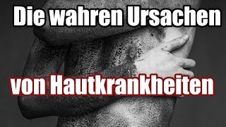 Was dir dein Arzt nicht sagt  Die wahren Ursachen von Hautkrankheiten Teil 12 [upl. by Beyer75]