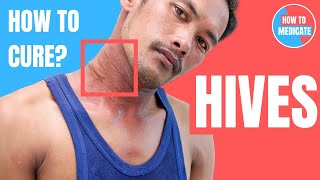 How to treat Hives Urticaria  Doctor Explains [upl. by Anawahs]