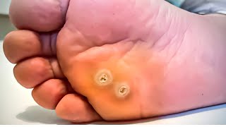 How To Remove a Foot Corn or Callus Foot Doctor Home Treatment [upl. by Giana458]