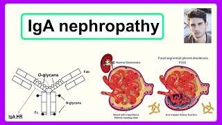 IgA nephropathy [upl. by Lokcin]