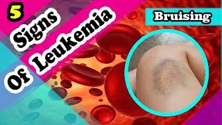 5 Leukemia Signs and Symptoms You Should Know [upl. by Peta]