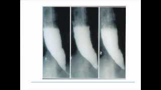 Esophageal Motility Disorders [upl. by Notaes]