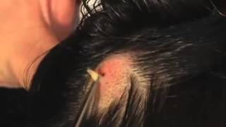 The Botfly in the Head [upl. by Narib]