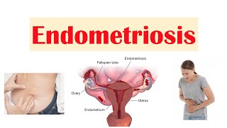 Endometriosis  Causes Pathophysiology Symptoms Diagnosis amp Treatment [upl. by Zahavi]