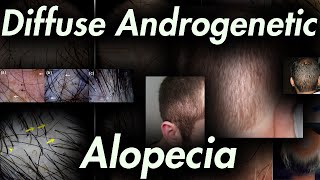 Its NOT Prolactin Hair Loss DUPA Androgenetic Alopecia Pattern Variations HMI115 and more [upl. by Aniehs]