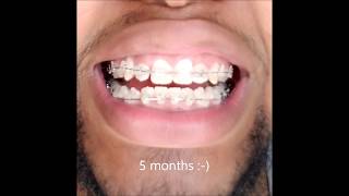 Braces 6 Month Timelapse [upl. by Imerej]