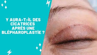 Y auratil des cicatrices après une blépharoplastie [upl. by Sailesh128]