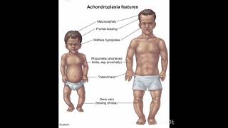 case1 achondroplasia شرح [upl. by Lienad452]