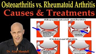 Osteoarthritis vs Rheumatoid Arthritis Causes amp Remedies  Dr Alan Mandell DC [upl. by Yud24]