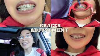 Braces Update CloseUps Adjustment Elastics  Overbite extractions adult braces [upl. by Neerahs]