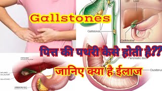 Gallstones  Cholelithiasis Choledocholithiasis sign amp symptomsdiagnosis amp treatment in hindi [upl. by Vonnie]