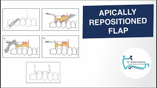 APICALLY REPOSITIONED FLAP PERIODONTAL FLAP SURGICAL TECHNIQUE DR ANKITA KOTECHA [upl. by Cavuoto863]