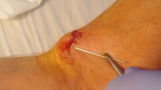 How To Give Yourself Stitches Sutures [upl. by Eilyw]