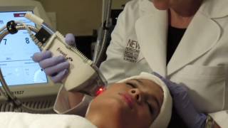 Fraxel Laser Treatment Chicago [upl. by Frederique869]