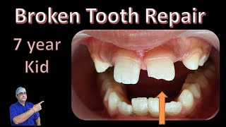 BROKEN TOOTH REPAIR IN A 7 YR OLD KID [upl. by Ynnahc]