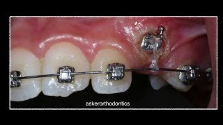 Exposure of unerupted canine using diathermy and orthodontic traction by Dr Amr Asker [upl. by Dyrraj]