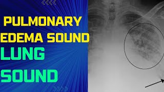 Pulmonary Edema Lung Sound Pulmonary Edema Sound Pulmonary Congestion [upl. by Amein]