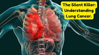 The Silent Killer Understanding Lung Cancer [upl. by Siskind]