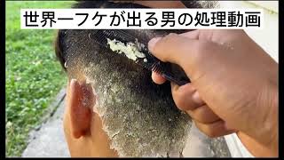 世界一フケが出る男のディープクリーニング動画 dandruff video treatment [upl. by Anemolihp]