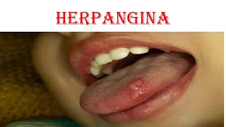 Herpangina [upl. by Annoirb]