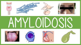 Understanding Amyloidosis [upl. by Carpet]