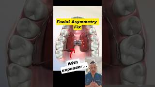 Fixing Facial Asymmetry with a Palate Expander Heres How dentallan dentist shorts [upl. by Coy]