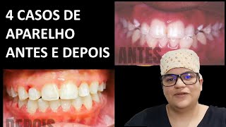 4 tratamentos de aparelho ANTES e DEPOIS realizados por mim  Dra Bianca Rosa  Clínica Bianca Rosa [upl. by Lecirg857]