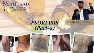 Homoeopathic medicines for psoriasis PSORIASIS PART  2 [upl. by Guss]