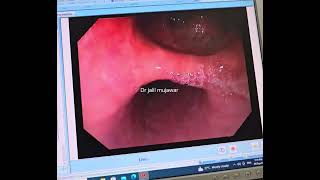 oesophageal diverticulum [upl. by Ellekram998]