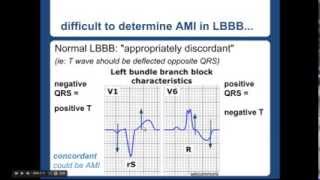 Sgarbossa Criteria  quotEM in 5quot [upl. by Hainahpez680]