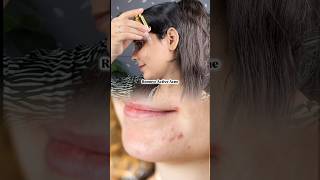 Shocking results remove acne amp acne marks in just 3 weeks skin acnetreatment [upl. by Elocal528]