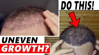 Uneven Growth after Hair Transplant DO THIS [upl. by Ynafets]