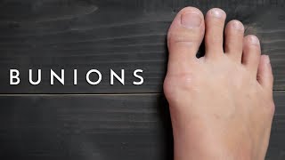 Bunions What a podiatrist can do to Help  Podiatrist Georgina Tay East Coast Podiatry [upl. by Block]