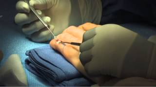 Treatment of Chronic Mallet Finger by Leo Rozmaryn MD [upl. by Attehcram]