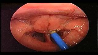 Adenoidectomy Surgery  Removal Of Adenoids  ENT Consultant London  ENT Surgeon London [upl. by Letnahs821]