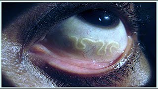 The Worms That Can Crawl Under Your Skin Zoonotic hookworm [upl. by Stew]